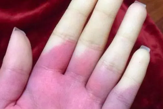 Red hand