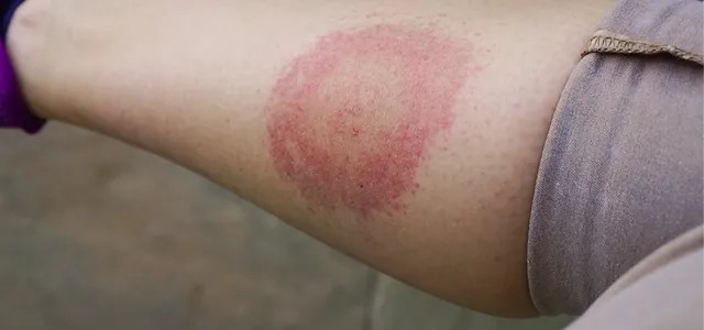 Skin Rash